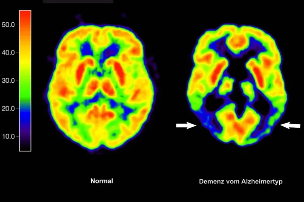 Neue Alzheimer-Therapie zugelassen – Hoffnung für Millionen Betroffene